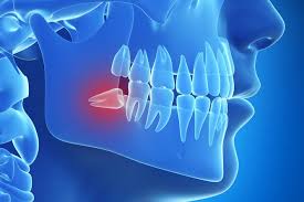 A picture of a hurting Wisdom Tooth