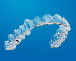 Clear Invisalign aligner tray held in front of a smile