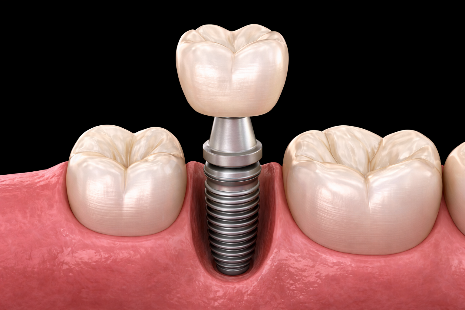 Implant crown being placed over a dental implant